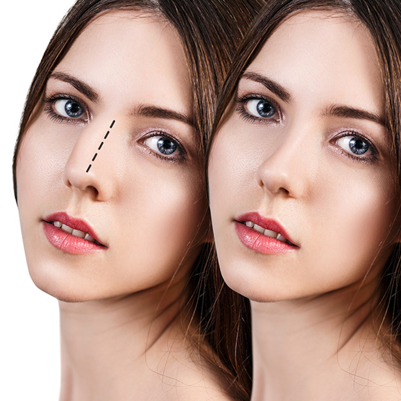 about-rhinoplasty-risks-alaska-s-news-feed-latest-news